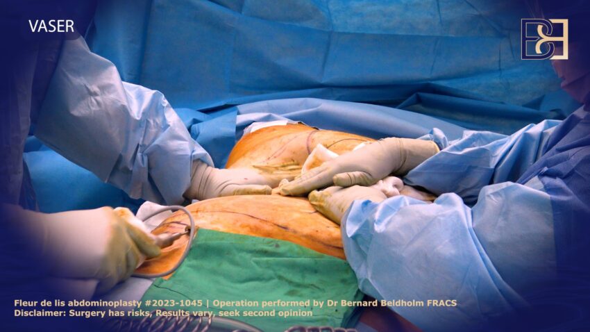 How Is Liposuction Used During an Abdominoplasty?